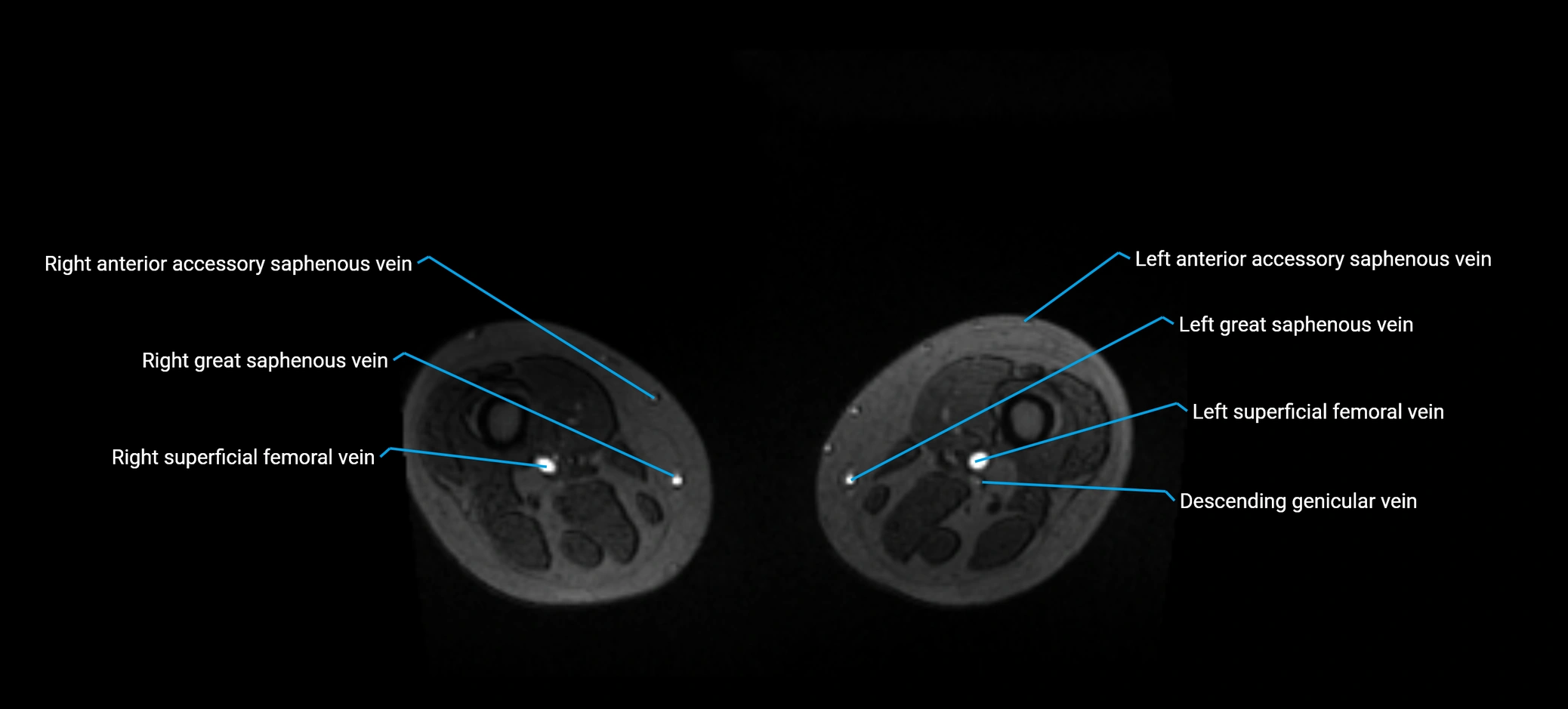 MRV abdomen pelvis & lower limb axial cross sectional anatomy labelled MRI image 313.webp